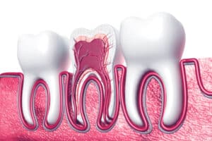 Pediatric Root Canal