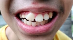 Do Pacifiers Cause Buck Teeth